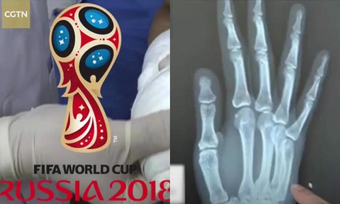 เจ็บนี้อีกนาน หนุ่มจีนเชียร์ฟุตบอลโลก ลุ้นหนักจน “มือหัก”