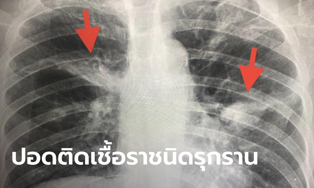 หมอมนูญ เตือนภัยใกล้ตัว ชายวัย 79 รื้อหนังสือเก่าๆ ในบ้าน หายใจเอาเชื้อราเข้าปอด