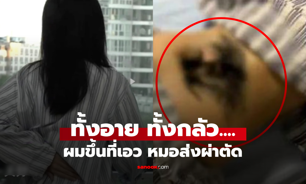 แปลกมาก! สาววัย 17 "ขนขึ้นที่เอว" ยาวดกดำเหมือนเส้นผม หมอต้องส่งผ่าตัดไขสันหลัง