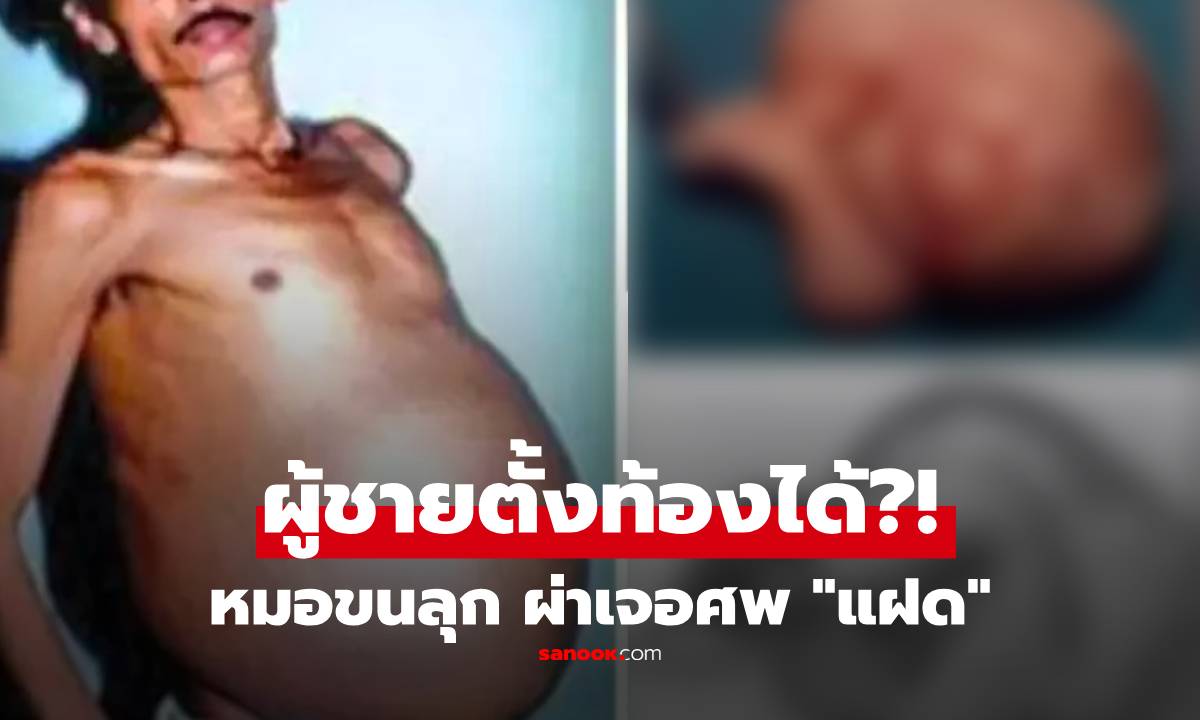 หมอขนลุก ผ่าท้องผู้ชายแท้ๆ เจอศพ "แฝด" อยู่ในท้องมานาน 36 ปี เจ้าตัวยังไม่กล้ามอง