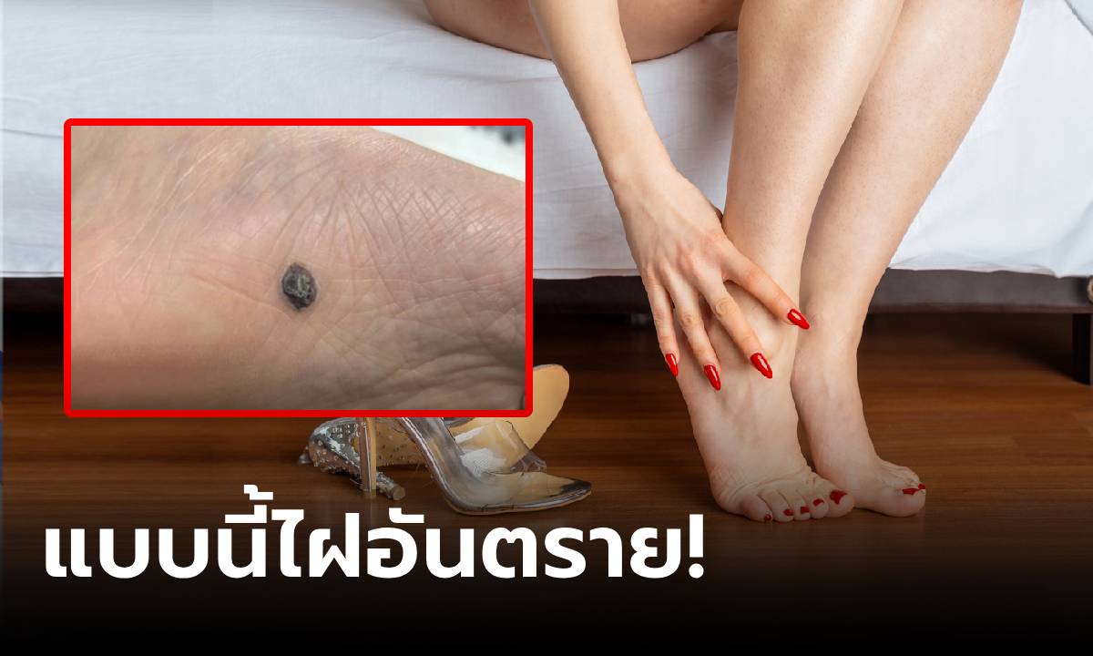 สาวมีไฝใต้ฝ่าเท้า ภูมิใจเป็น "ไฝนำโชค" แต่หมอเห็นรู้เลย "มะเร็ง" ชี้ชัดๆ จุดต่างอยู่ตรงนี้