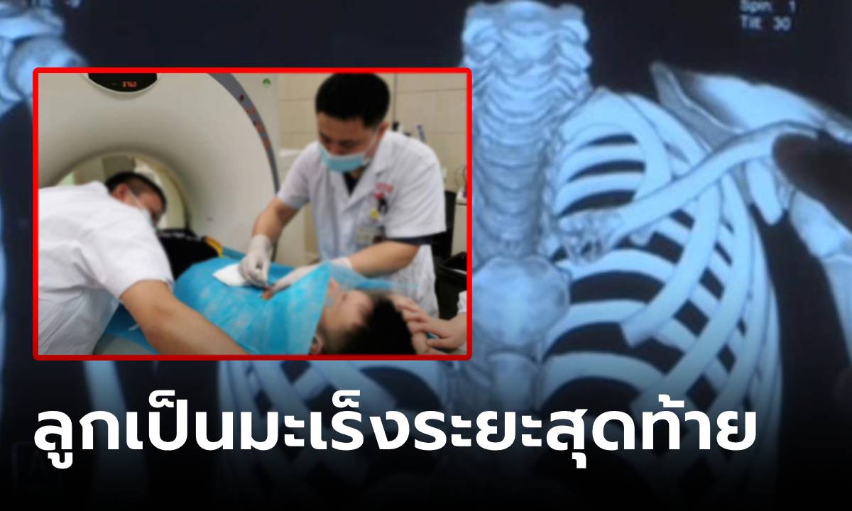 ลูกชายวัย 12 ป่วยมะเร็งปอด "ระยะสุดท้าย" พ่อแม่ฟังแล้วทรุด หมอชี้พลาดที่การกิน-นอน