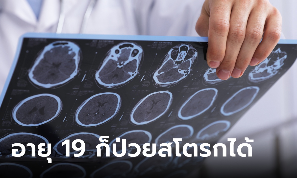 หนุ่มอายุแค่ 19 ป่วยหลอดเลือดสมองตีบ เผยนิสัย 5 ข้อที่ทำประจำ หมอรู้แล้วกุมขมับ