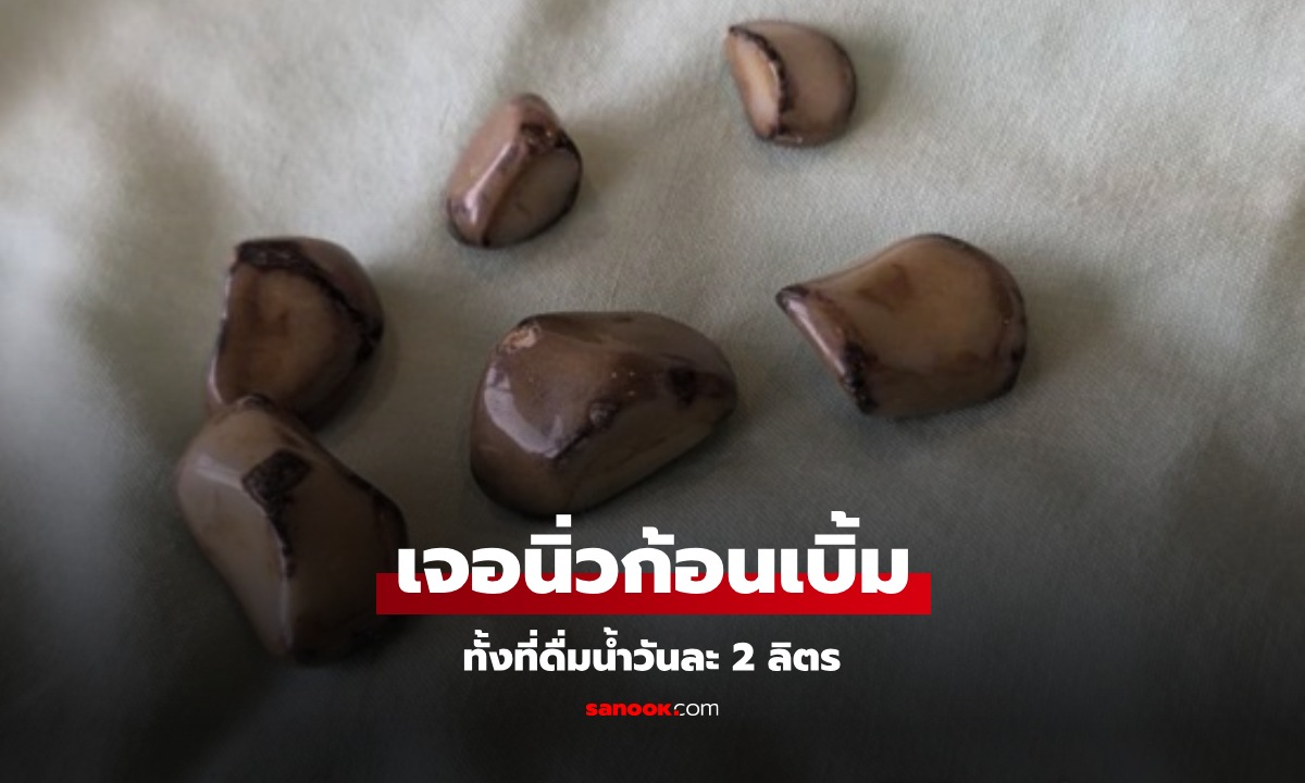 ชายวัย 58 ช็อก ดื่มน้ำวันละ 2 ลิตร! แต่พบ \