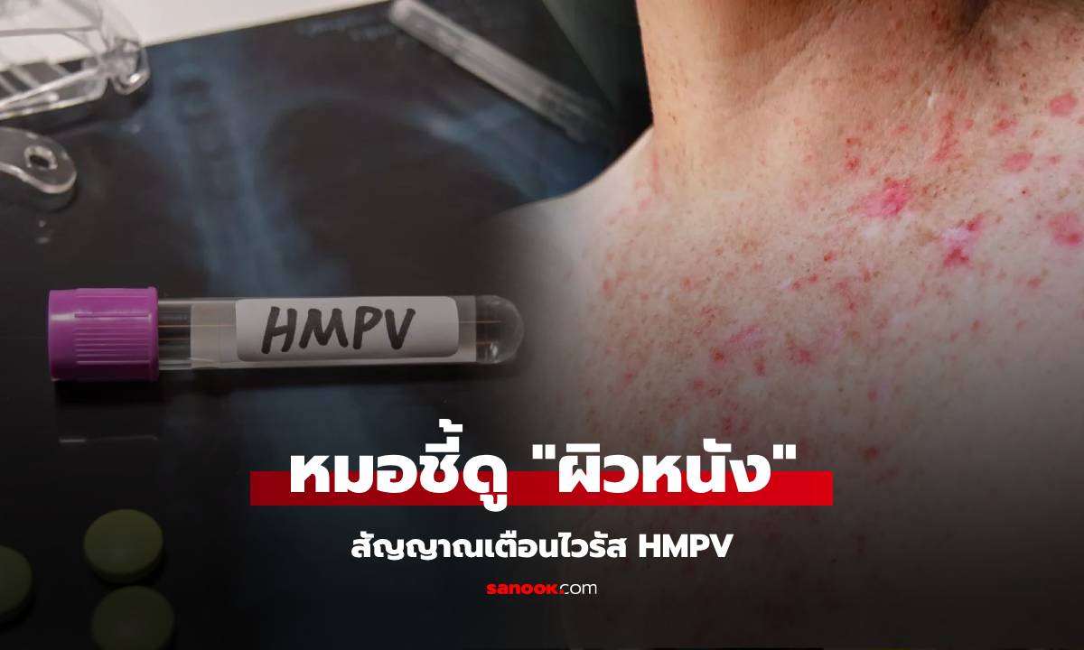 รู้ไว้ดีกว่า! แพทย์อังกฤษเผย สัญญาณเตือนไวรัส HMPV ที่สามารถเห็นได้บน \