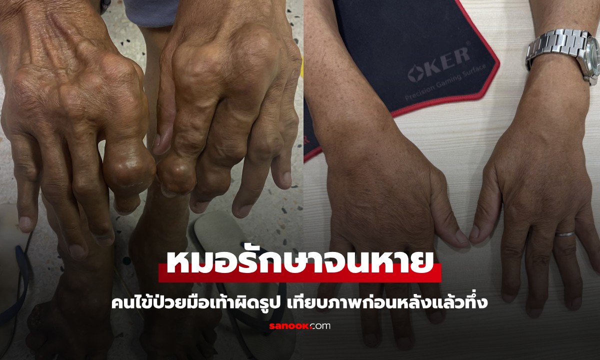 ใครเห็นก็ทึ่ง! แพทย์ รพ.สุโขทัย รักษาผู้ป่วยโรคเก๊าท์ มือ-เท้าผิดรูป ดีขึ้นเหมือนคนละคน