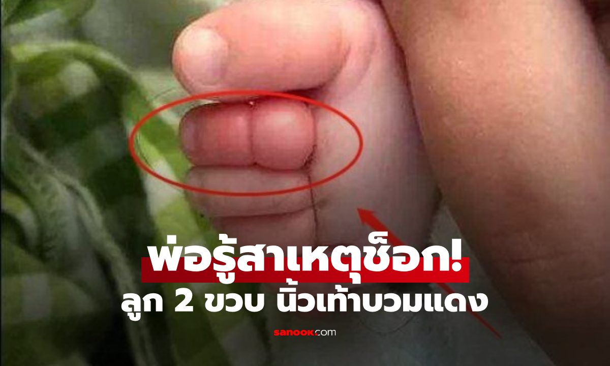 พ่อพาลูก 2 ขวบไปว่ายน้ำ 2 วันต่อมาร้องเจ็บ หวิดโดน \