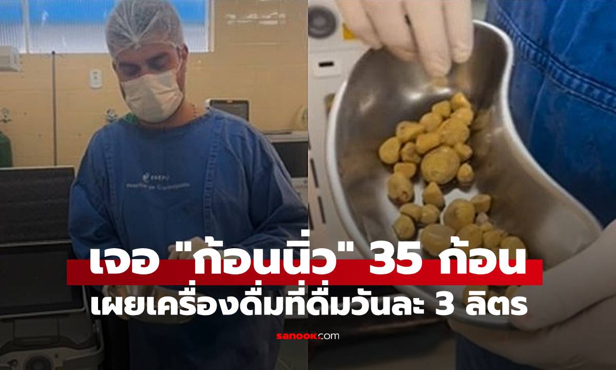 ชายมี "ก้อนนิ่ว" ในกระเพาะปัสสาวะ 35 ก้อน หายสงสัยเมื่อรู้เครื่องดื่มโปรด ดื่มวันละ 3 ลิตร