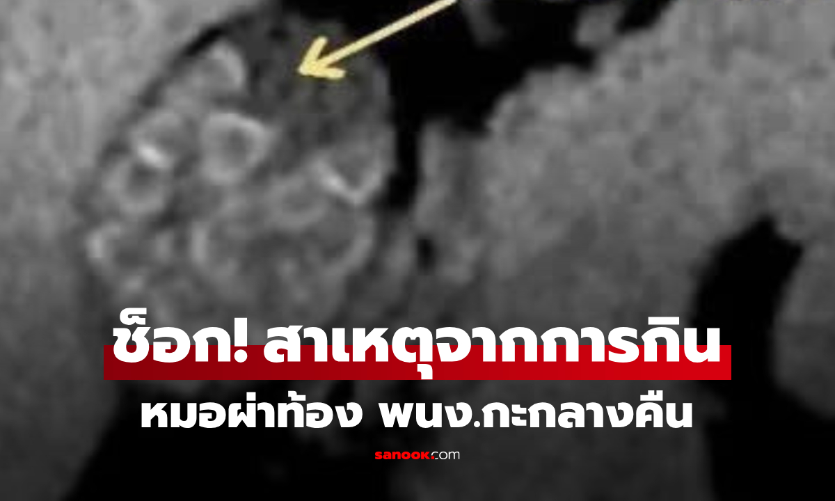 ผ่าท้องหญิง พนง.กะดึก แพทย์สะพรึง \