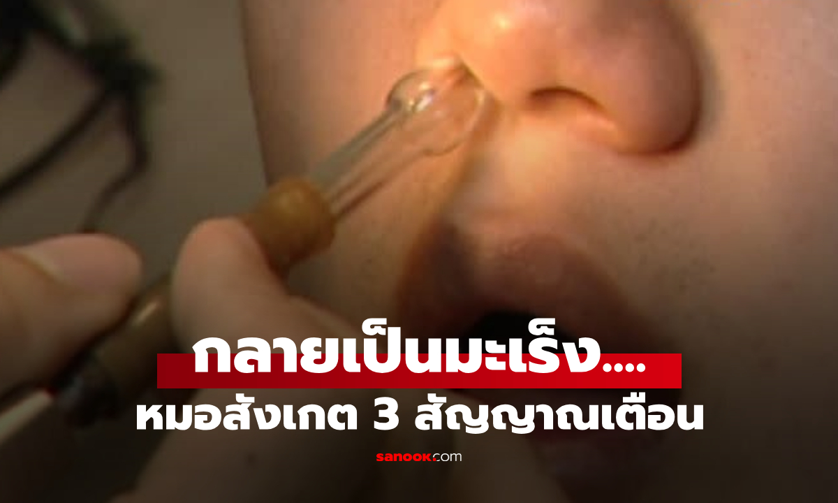 ชายคัดจมูกไม่หาย หมอสังเกต 3 อาการ ส่งตรวจ \