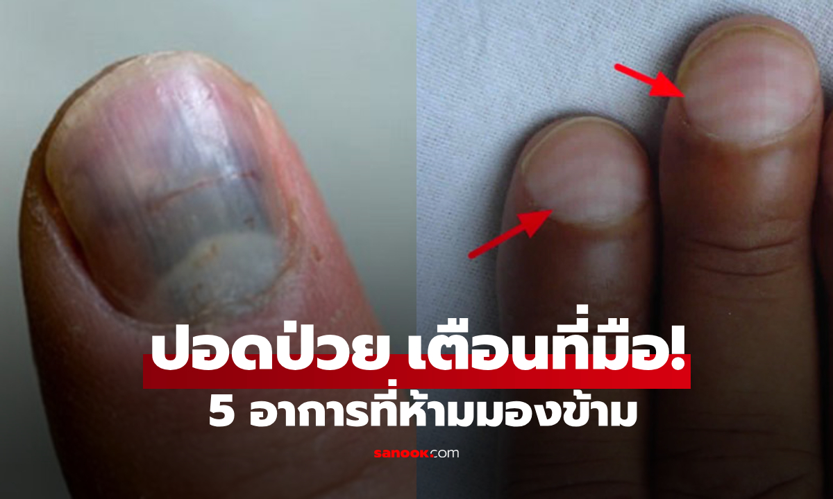 รู้ให้ทันโรคในตัว! เช็ก 5 เบาะแสบนมือ บ่งชี้ \