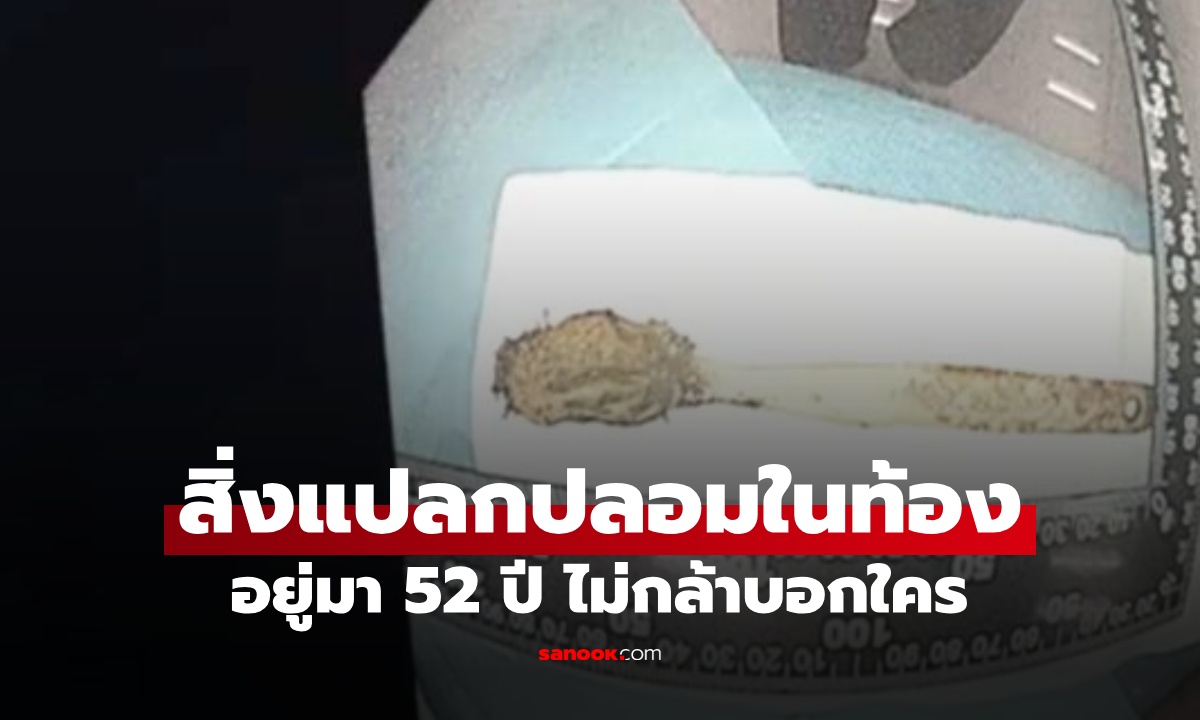 ชายชราเจ็บหน้าอกเรื้อรัง หมอช็อกต้นเหตุ "สิ่งแปลกปลอม" อยู่ในร่างกายมานาน 52 ปี