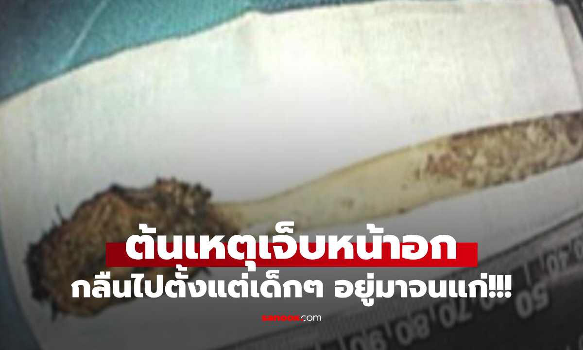 หมอช็อก! ชายเจ็บหน้าอก ส่องกล้องเจอ \