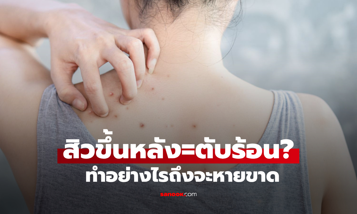 สะอาดแล้วแต่ยังมี  “สิวที่หลัง” เกิดจากตับร้อนใช่ไหม ทำยังไงถึงจะหายขาด?!