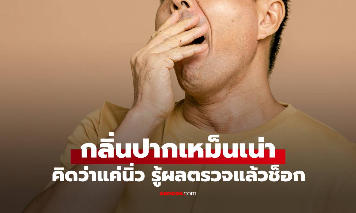 ชายวัย 50 มีกลิ่นปากเหม็นคล้ายของเน่า คิดว่าแค่นิ่ว พอไปหาหมอ ช็อกเป็นมะเร็ง