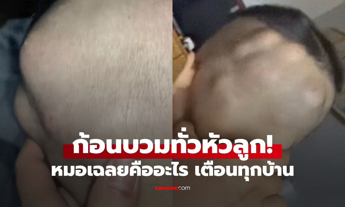 แม่ช็อกมือสั่น ก้อนๆ ปูดเต็มหัวลูกชาย หมอเฉลยคืออะไร ไม่ใช่เนื้องอก แต่ทุกบ้านควรระวัง!