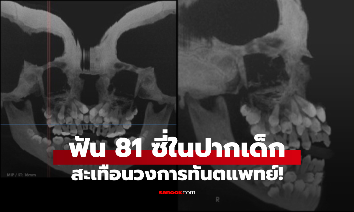 เอ็กซ์เรย์สะพรึง 81 ซี่ในปากเด็ก ไม่ได้มีแค่ฟันแท้-ฟันน้ำนม สะเทือนวงการทันตแพทย์!