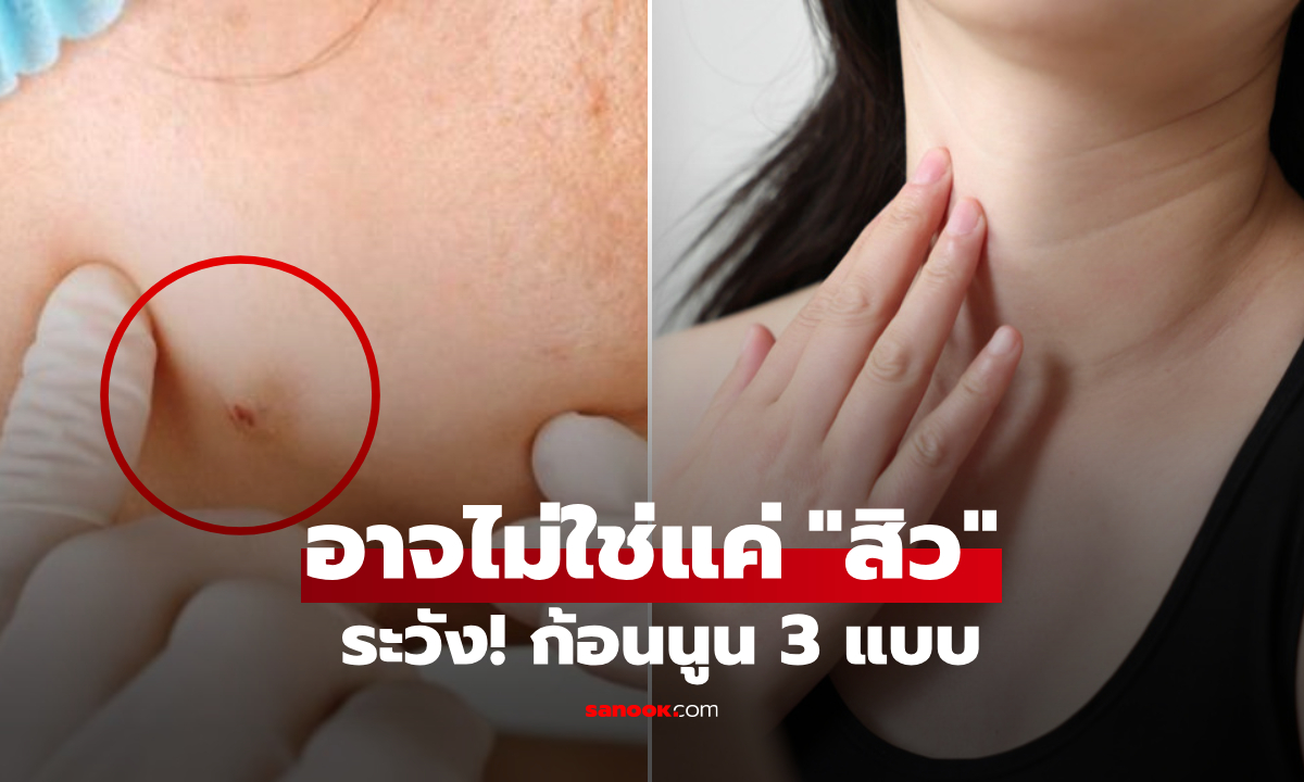 อย่าคิดว่าแค่สิวๆ เตือน \