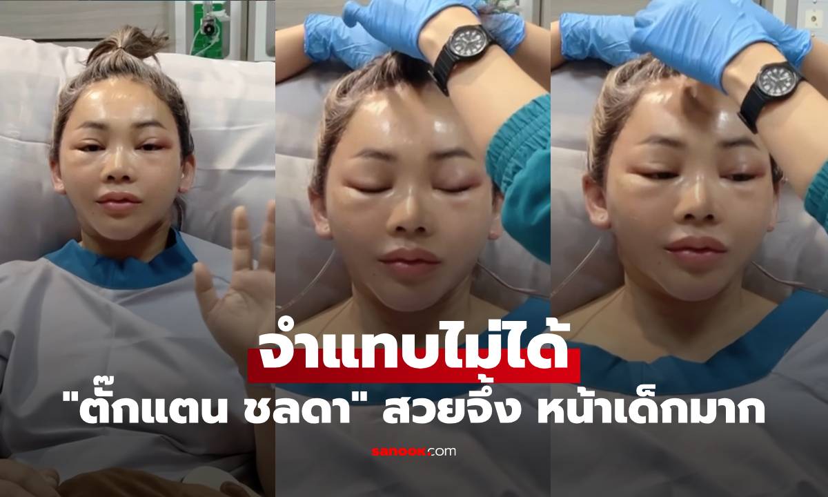 จำแทบไม่ได้ "ตั๊กแตน ชลดา" ขึ้นเขียงศัลยกรรม สวยจึ้ง หน้าเด็กมาก