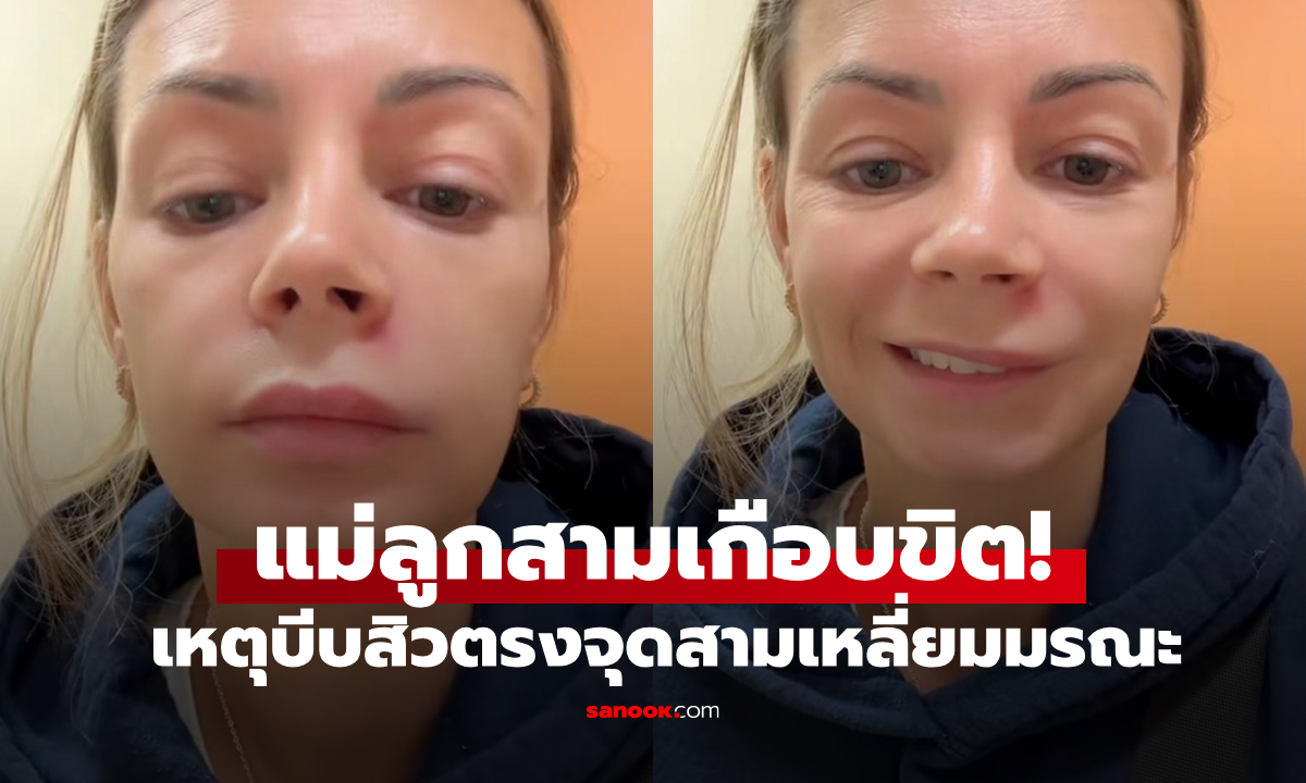 แม่ลูก 3 แชร์อุทาหรณ์! พลาดบีบสิวตรงจุด \