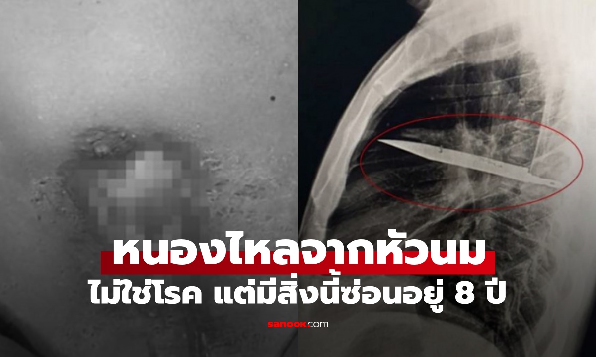หมอตกตะลึง คนไข้หนองไหลจากหัวนมขวา ไม่ได้เป็นโรค แต่มี \