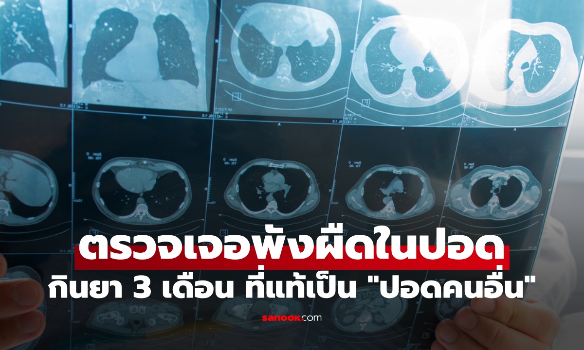 คนไข้อึ้ง หมอบอกเป็นพังผืดในปอด กินยา 3 เดือน จริงๆ ที่ป่วยคือ \