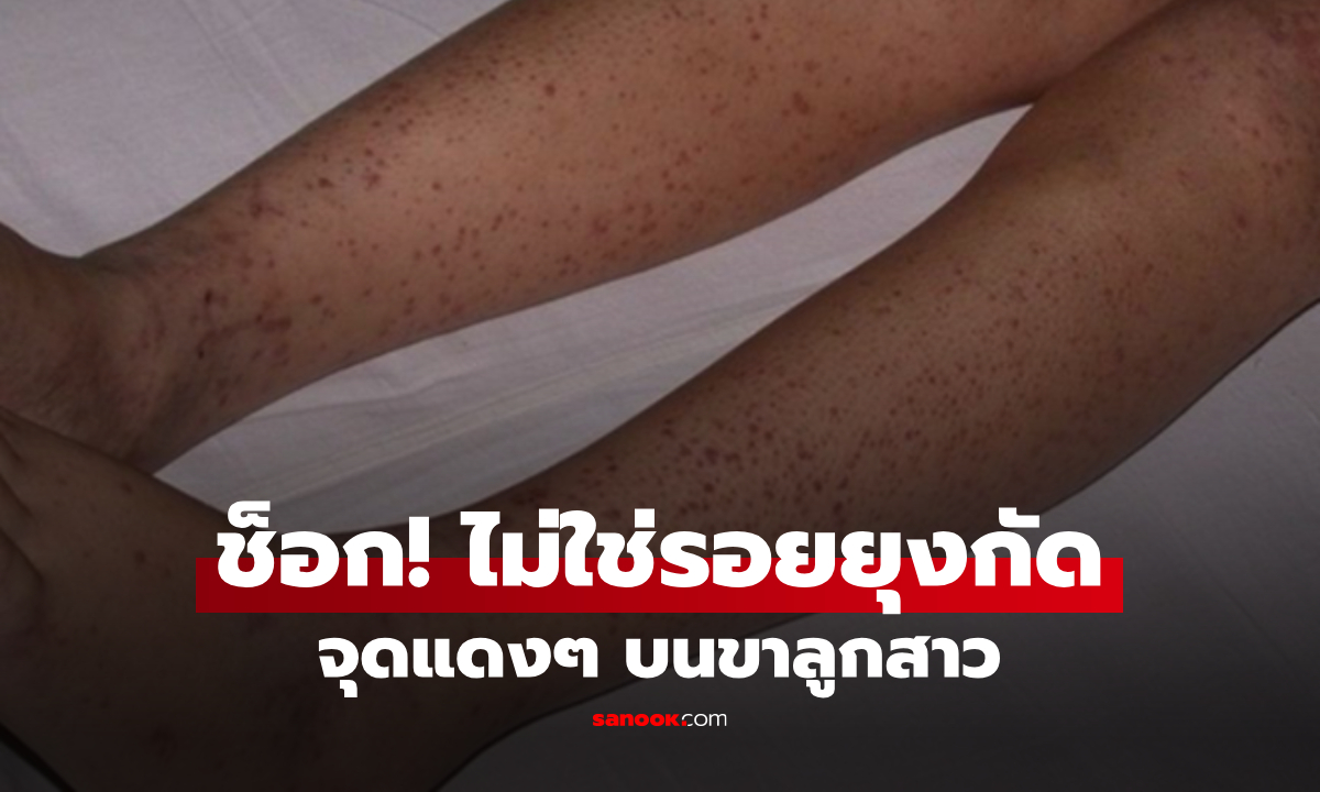 อาบน้ำให้ลูก พบจุดแดงๆ ตามขา นึกว่าแค่ยุงกัด แต่ผลตรวจชี้ \