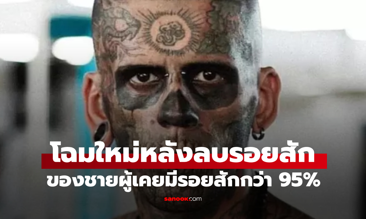 ชายผู้มีรอยสักกว่า 95% ทั่วร่างกาย เผยการเปลี่ยนแปลงสุดทึ่ง หลังเลเซอร์ลบรอยสัก