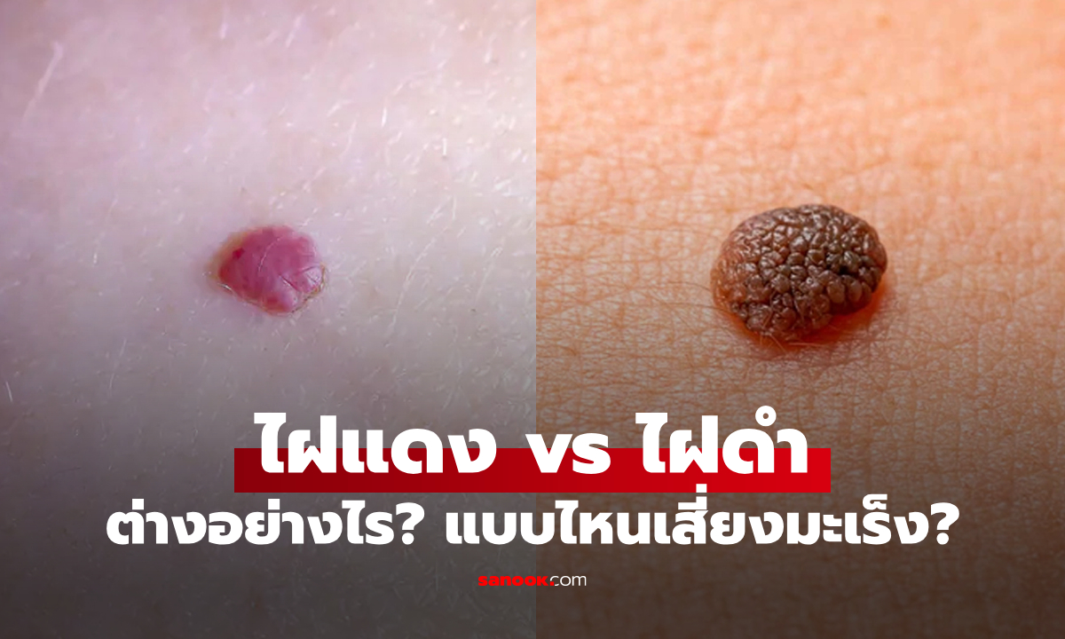ไฝแดง vs ไฝดำ: ต่างกันอย่างไร? แบบไหนเสี่ยงเป็นมะเร็งได้?