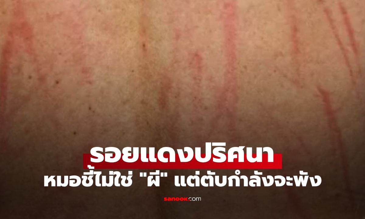 รอยแดงทั่วตัว เชื่อเป็นฝีมือ \