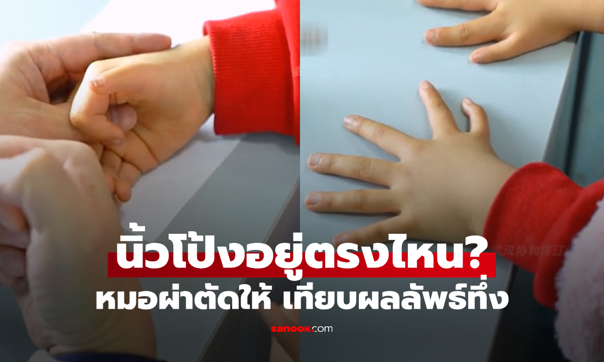 ด.ญ.นิ้วมือไม่เหมือนใคร คนแห่สงสัย \