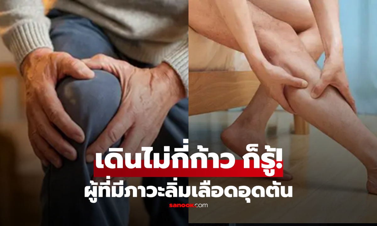รู้ไว้ดีกว่า! ผู้มีภาวะลิ่มเลือดอุดตัน สังเกตได้ \