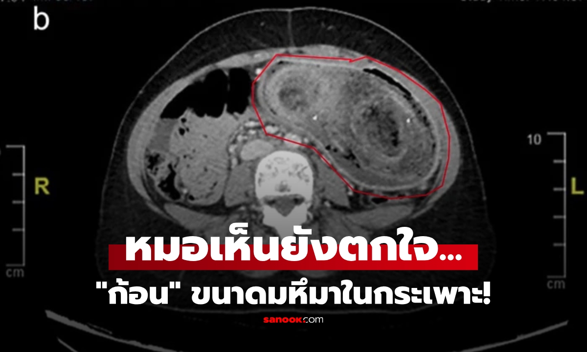 เด็กสาววัย 17 ปวดท้อง-อาเจียนไม่หยุด หมอตกใจเห็น \