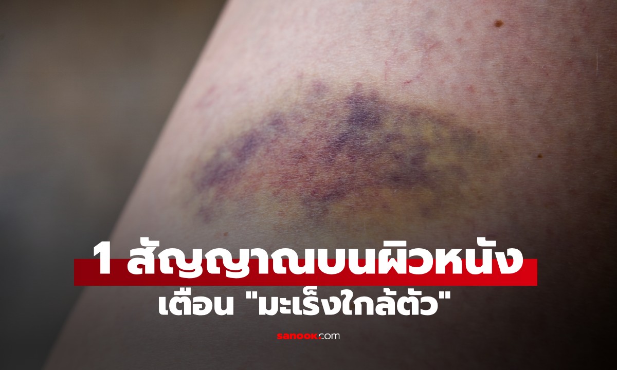 1 สัญญาณบนผิวหนังเตือน \