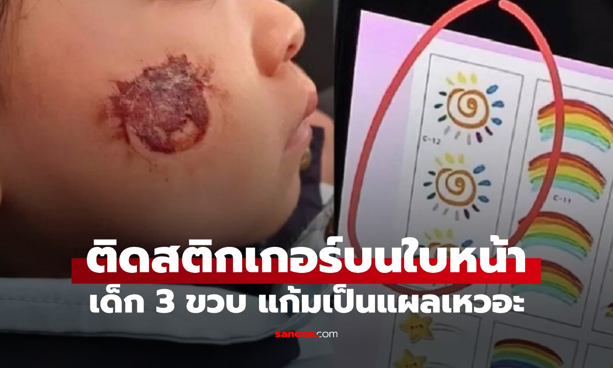 อุทาหรณ์ เด็กหญิง 3 ขวบ ติดสติกเกอร์ในงานโรงเรียน สุดท้ายหน้าเป็นแผลเหวอะ