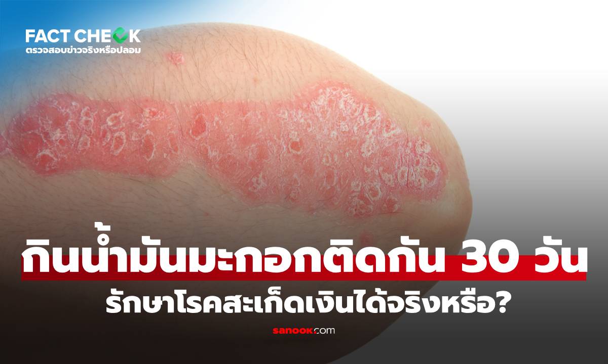 เช็กข่าวชัวร์ : กินน้ำมันมะกอกติดกัน 30 วัน รักษาโรคสะเก็ดเงินได้จริงหรือ?