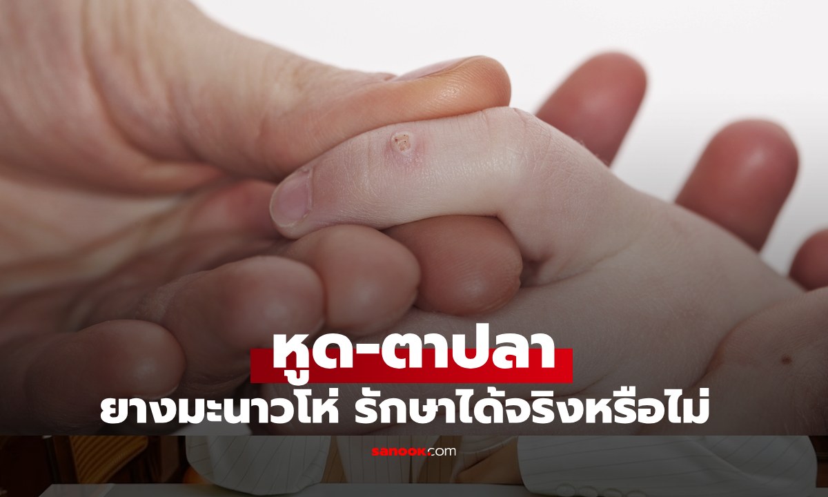 เช็กข่าวชัวร์ : ยางมะนาวโห่ รักษาหูด-ตาปลา หายขาดจริงหรือไม่?