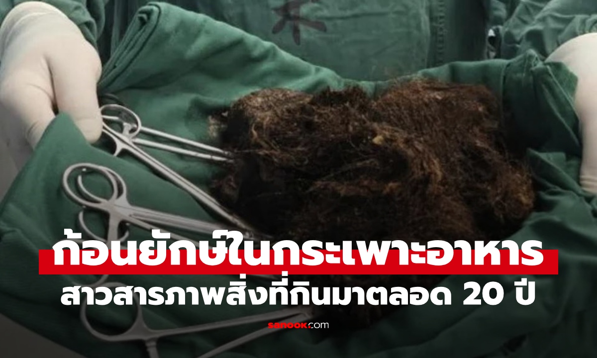 สาวท้องแข็งเป็นหิน หมอผ่ากระเพาะเจอ \