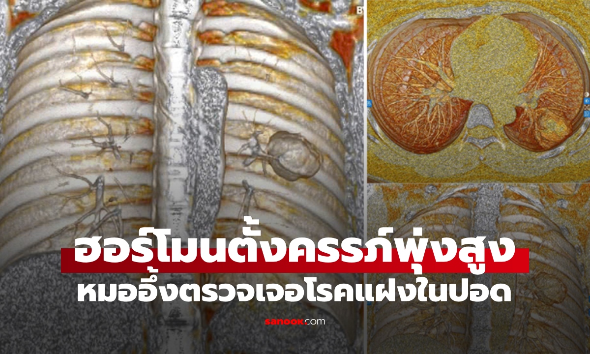 สาววัย 36 ฮอร์โมนตั้งครรภ์พุ่งสูง ทั้งที่ไม่ได้ท้อง รู้สาเหตุหมออึ้ง คนไข้แทบล้มทั้งยืน