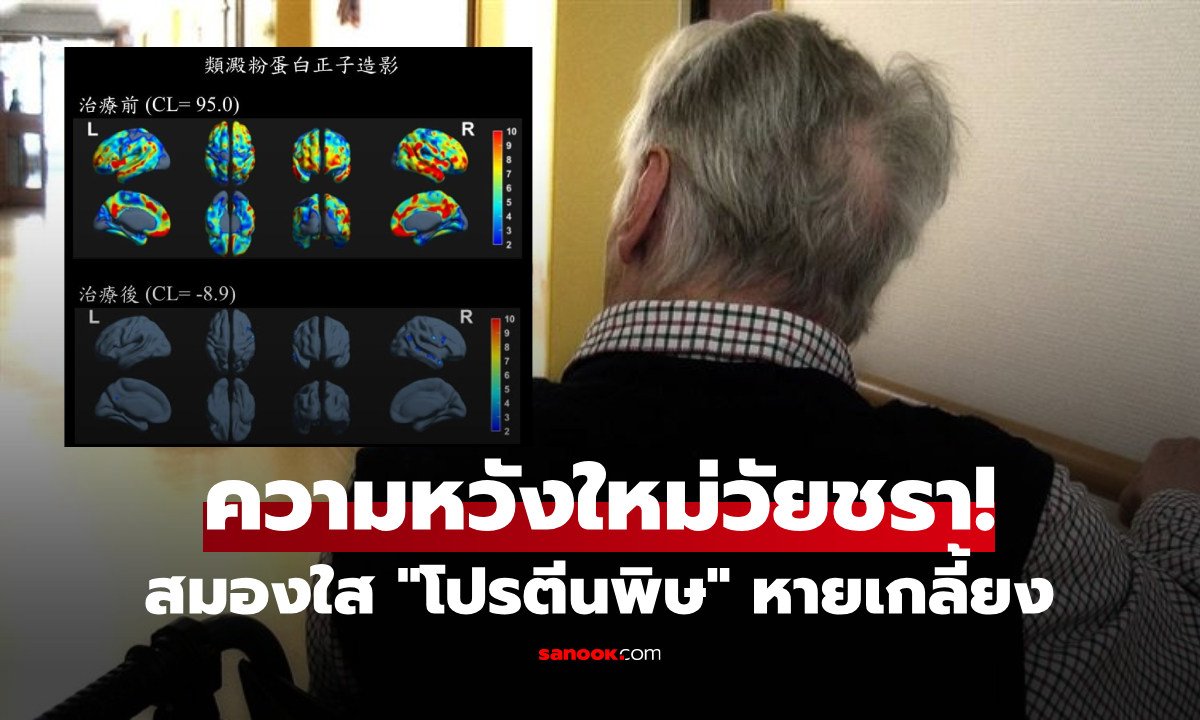 ปาฏิหาริย์การแพทย์! เถ้าแก่วัย 76 ป่วยอัลไซเมอร์ \