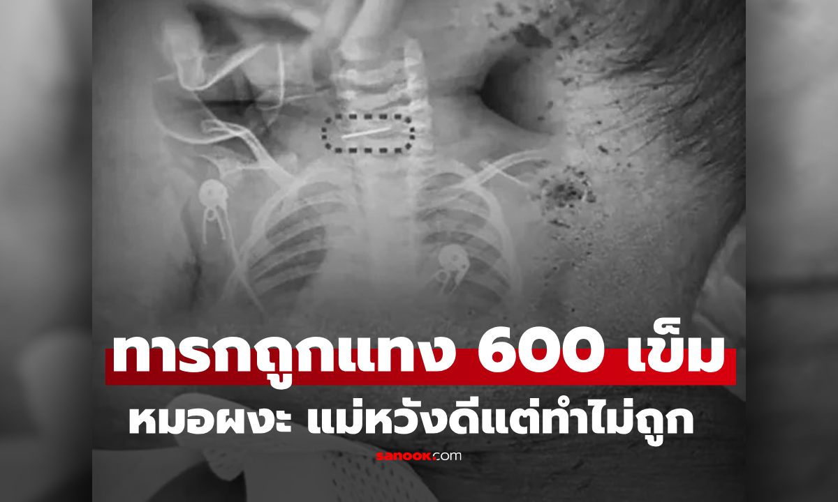 หวังดีแต่เกือบไม่รอด! ทารก 10 เดือน ถูกแม่แทงกว่า 600 เข็มทั่วร่าง อึ้ง บางจุดลึกถึงกระดูก