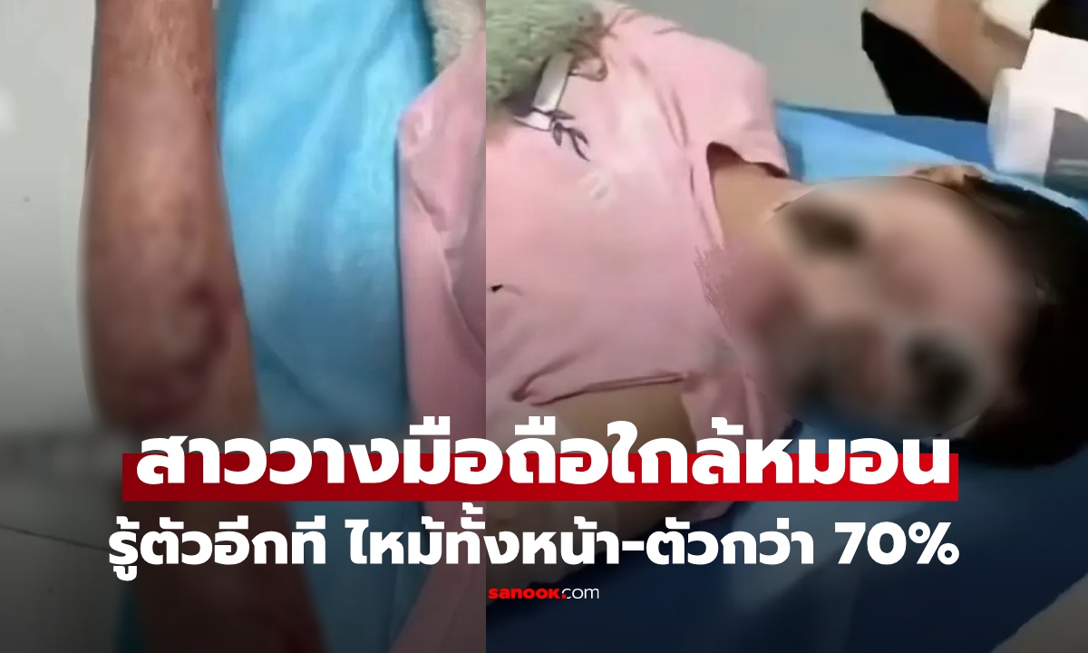 ใครทำอยู่เลิกซะ! สาวชาร์จมือถือข้ามคืน วางข้างหมอน ตื่นมาเสียโฉม แผลไหม้หนัก 70%