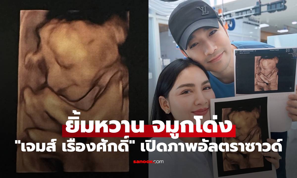 "เจมส์ เรืองศักดิ์" เปิดภาพอัลตราซาวด์ "น้องมีเมตตา" ยิ้มหวาน จมูกโด่งตั้งแต่อยู่ในท้อง