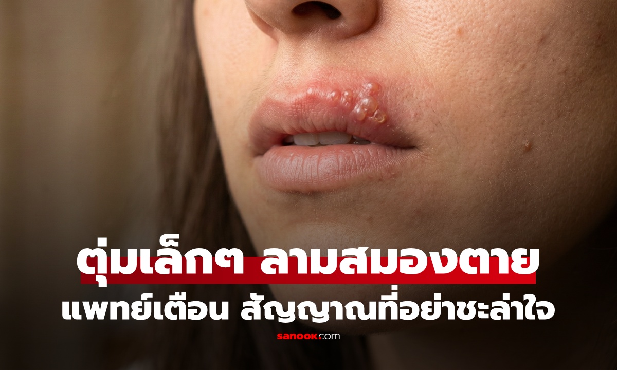 แค่ตุ่มน้ำที่ปาก…ใครจะคิดว่าจบที่ "สมองตาย" แพทย์เตือน สัญญาณเล็กๆ ที่อย่าชะล่าใจ
