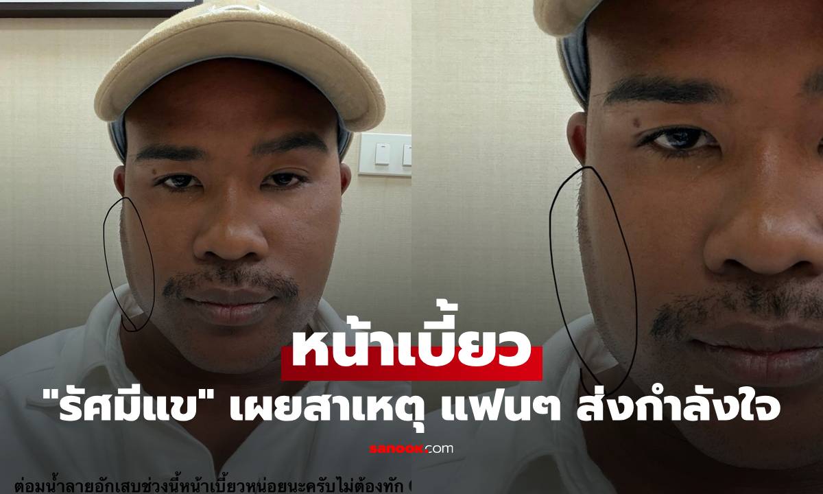 "รัศมีแข" เผยภาพหน้าเบี้ยว พร้อมสาเหตุที่ชัดเจน แฟนๆ ส่งกำลังใจเพียบ