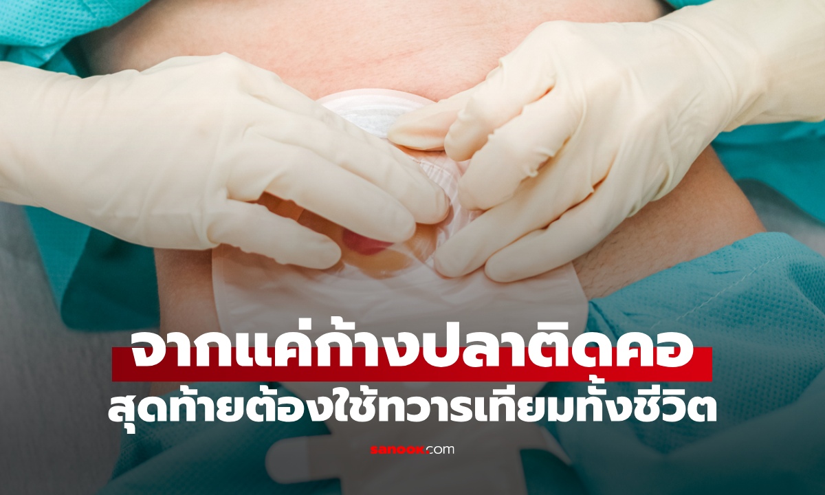 บทเรียนราคาแพง ก้างปลาติดคอเลยกลืนข้าวคำโตๆ สุดท้ายต้องใช้ "ทวารเทียม" ตลอดชีวิต