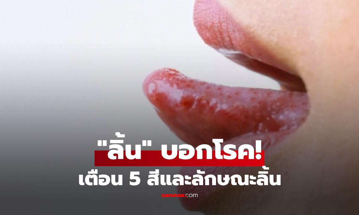 5 สัญญาณบน "ลิ้น" เตือนภัยโรคร้ายแรง ตั้งแต่ตับ-เบาหวาน-อัมพฤกษ์ ไปจนถึงมะเร็ง เช็กที่นี่!
