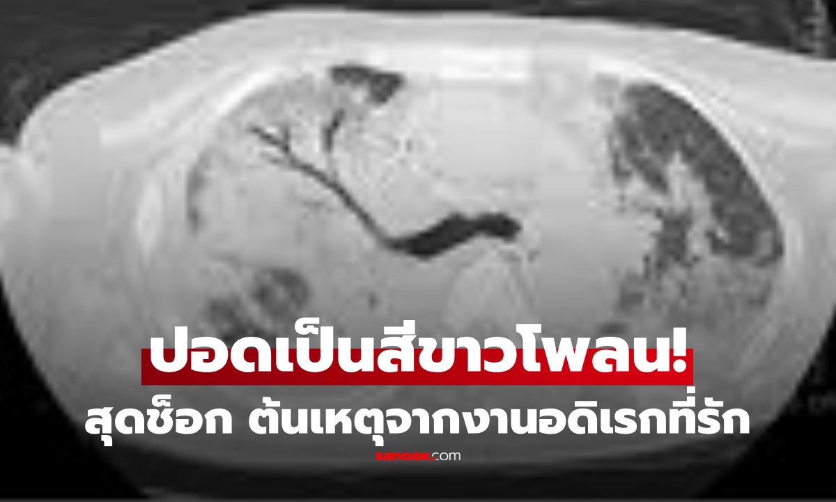 ตะลึง! ภาพสแกนปอดชายขับรถบรรทุก "ขาวโพลน" ทั้งตับ-ไตเสียหาย พบต้นเหตุจากงานอดิเรกที่รัก