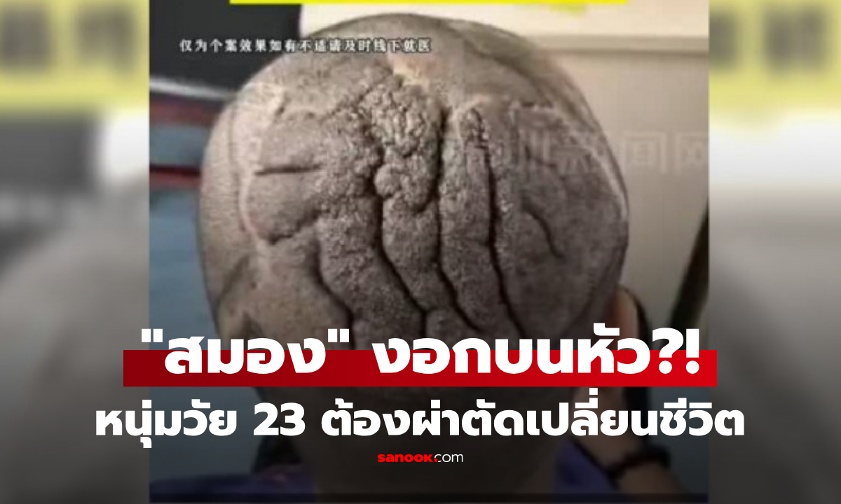 ป่วยโรคอะไร? หนุ่มวัย 23 "สมองงอกบนหัว" รักษานานเกือบปี ผ่าตัดสำเร็จเปลี่ยนชีวิต