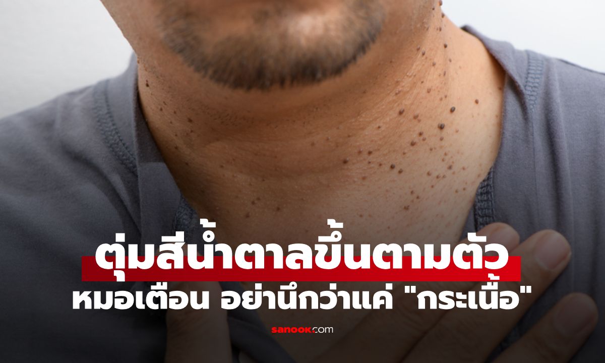 ตุ่มสีน้ำตาลขึ้นตามตัว อย่าคิดว่าแค่ "กระเนื้อ" หมอเตือน 2 สัญญาณเสี่ยงมะเร็งร้าย